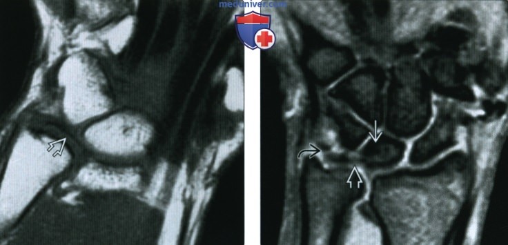 Рентгенограмма, МРТ при относительном расположении локтевой кости