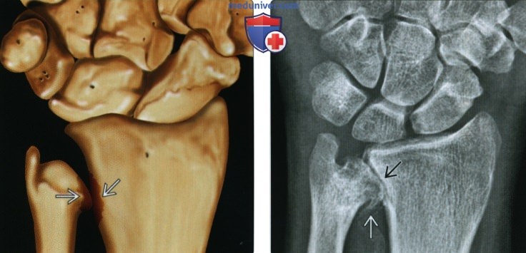 Рентгенограмма, МРТ при относительном расположении локтевой кости