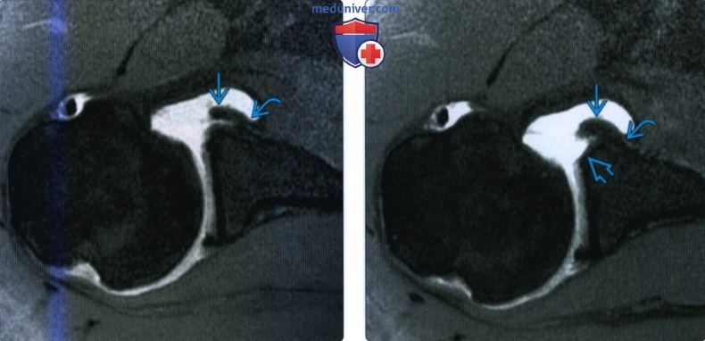 Рентгенограмма, МРТ при отрыве передней губы плечевого сустава без отделения от периостальной манжеты
