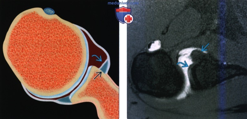 Рентгенограмма, МРТ при отрыве передней губы плечевого сустава без отделения от периостальной манжеты