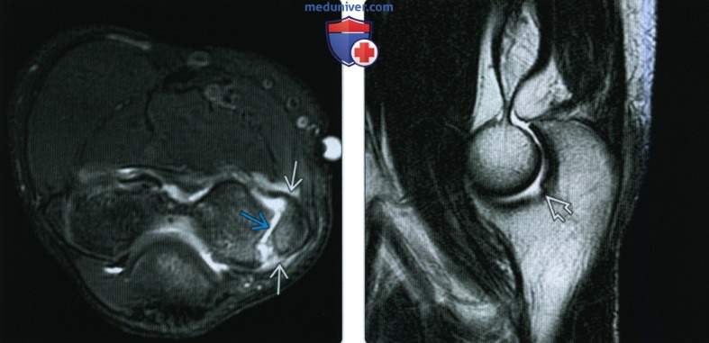 Рентгенограмма, МРТ при переломе локтевого отростка