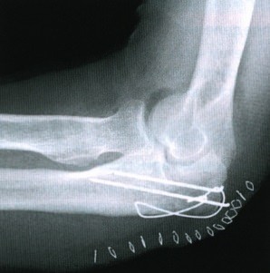 Рентгенограмма, МРТ при переломе локтевого отростка