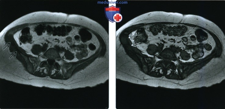 Рентгенограмма, МРТ, ПЭТ костного мозга при метастазах