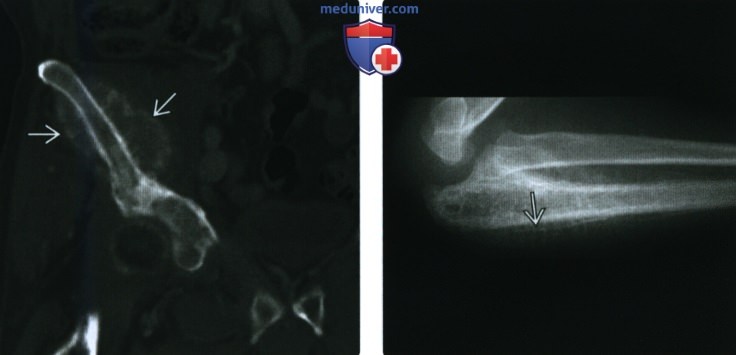 Рентгенограмма, МРТ, ПЭТ костного мозга при метастазах
