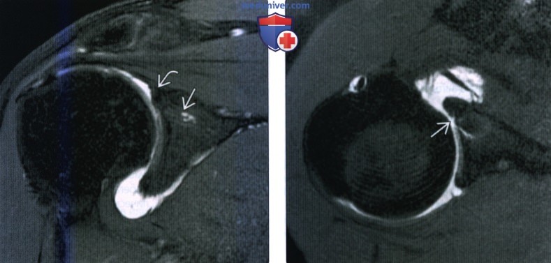 Рентгенограмма, МРТ после пластики повреждения Банкарта, пластики переднего и заднего разрыва верхней губы плечевого сустава