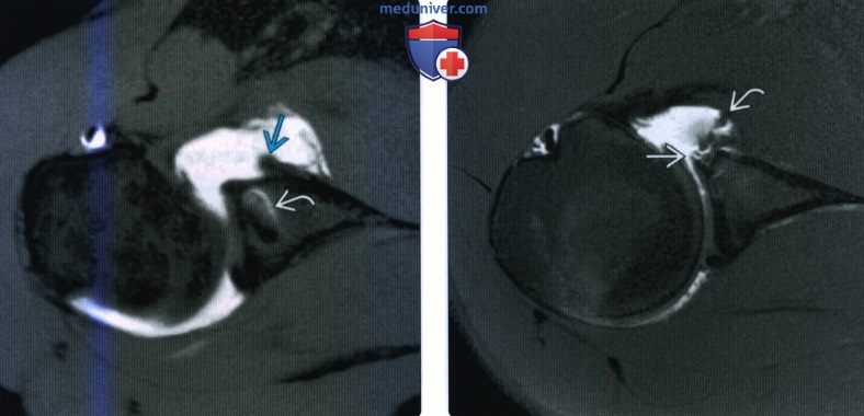 Рентгенограмма, МРТ после пластики повреждения Банкарта, пластики переднего и заднего разрыва верхней губы плечевого сустава