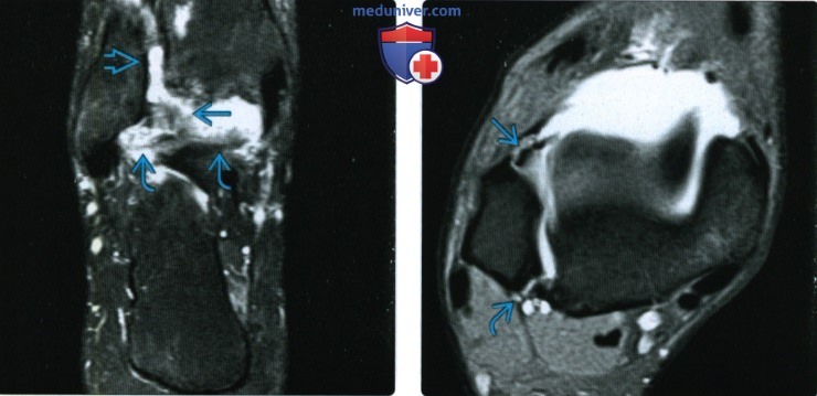 Рентгенограмма, МРТ при повреждении межберцового синдесмоза