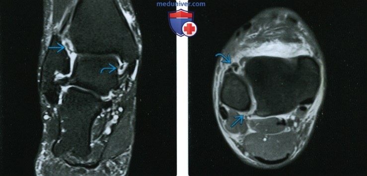 Рентгенограмма, МРТ при повреждении межберцового синдесмоза