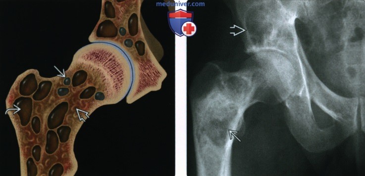 Рентгенограмма, МРТ при фиброзной дисплазии