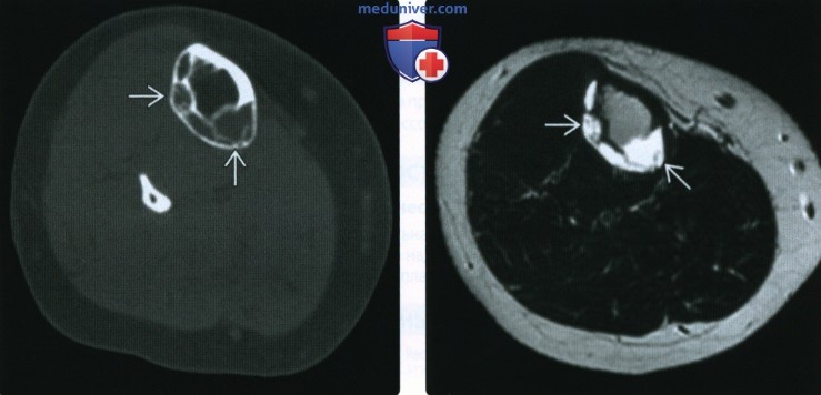 Рентгенограмма, МРТ при фиброзной дисплазии