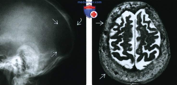 Рентгенограмма, МРТ при болезни Педжета