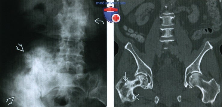 Рентгенограмма, МРТ при болезни Педжета