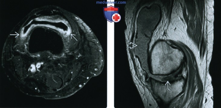 Рентгенограмма, МРТ при ревматоидном артрите коленного сустава