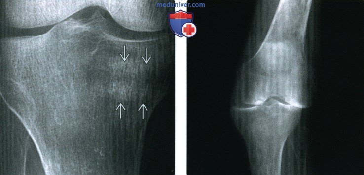Рентгенограмма, МРТ при ревматоидном артрите коленного сустава