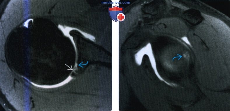 Рентгенограмма, МРТ при разрыве задней губы плечевого сустава