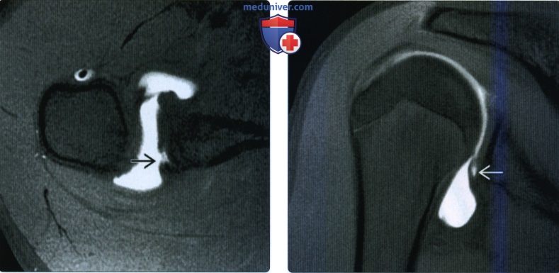Рентгенограмма, МРТ при разрыве задней губы плечевого сустава