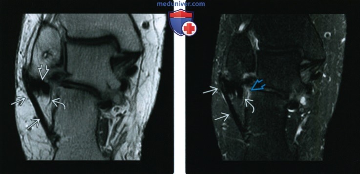 Рентгенограмма, МРТ после реконструкции латеральных связок голеностопного сустава