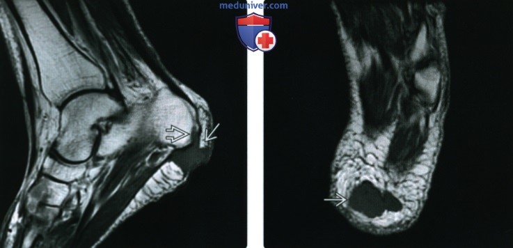 Рентгенограмма, МРТ при ревматоидном узелке