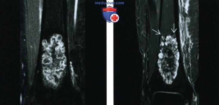 Рентгенограмма, МРТ, сцинтиграфия при энхондроме