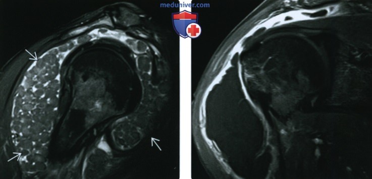 Рентгенограмма, МРТ при синовиальном хондроматозе