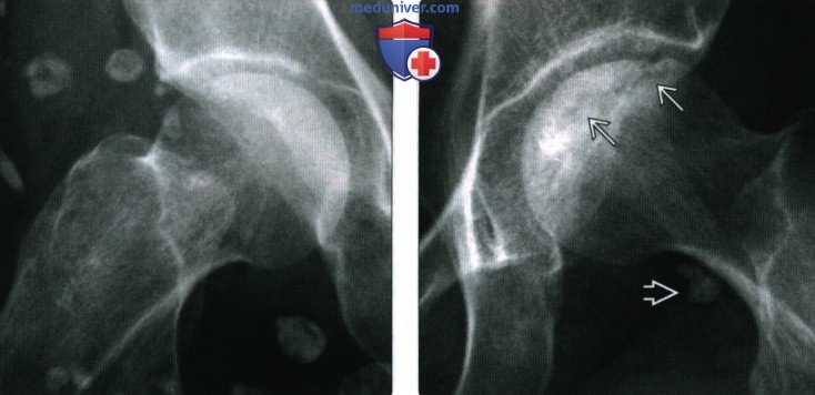 Рентгенограмма, МРТ суставов при системной красной волчанке (СКВ)