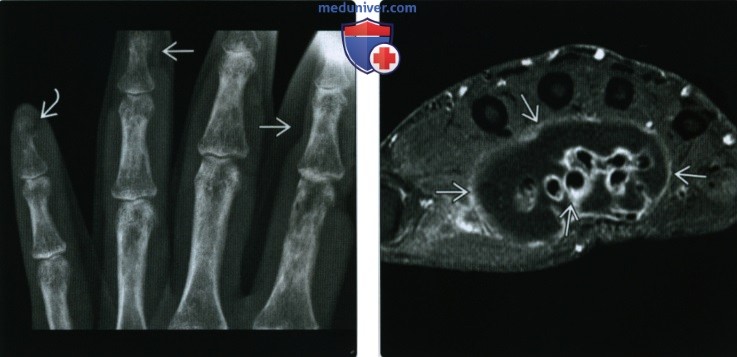 Рентгенограмма, МРТ суставов при системной красной волчанке (СКВ)