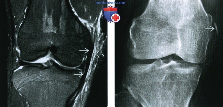 Рентгенограмма, МРТ при травме медиальной коллатеральной связки коленного сустава