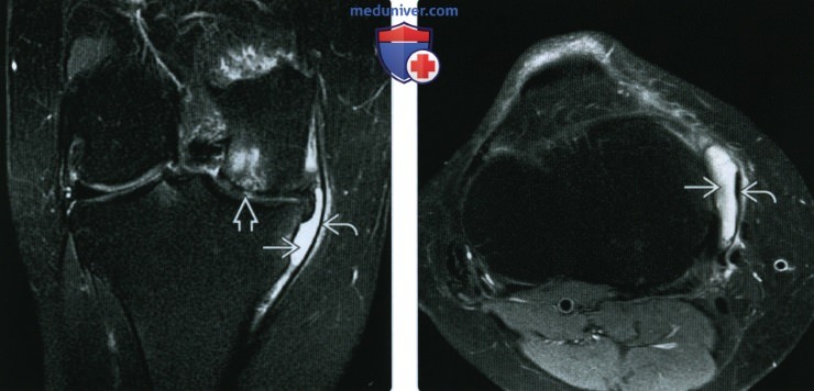 Рентгенограмма, МРТ при травме медиальной коллатеральной связки коленного сустава