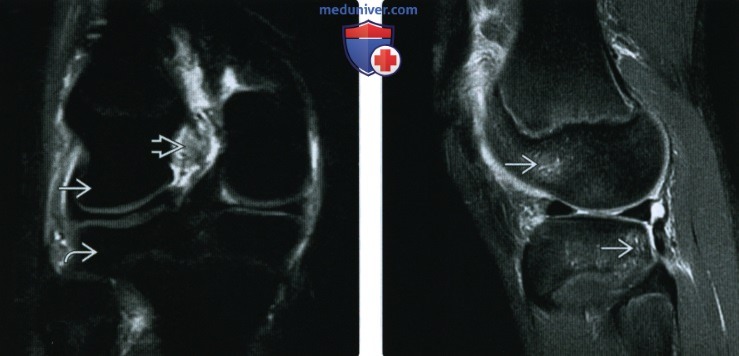 Рентгенограмма, МРТ при травме передней крестообразной связки