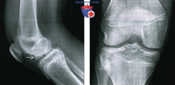 Рентгенограмма, МРТ при травме передней крестообразной связки