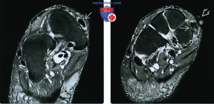 Рентгенограмма, МРТ при разрыве и тендинопатии сухожилий разгибателей стопы