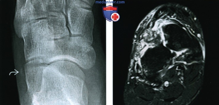 Рентгенограмма, МРТ при разрыве и тендинопатии сухожилий разгибателей стопы