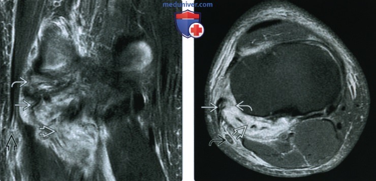 Рентгенограмма, МРТ при травме заднебокового угла коленного сустава