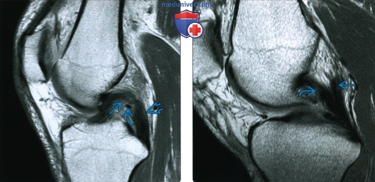 Рентгенограмма, МРТ при травме задней крестообразной связки