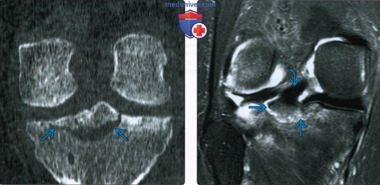 Рентгенограмма, МРТ при травме задней крестообразной связки