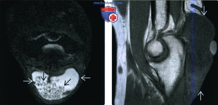 Рентгенограмма, МРТ, УЗИ при бурсите локтевого сустава