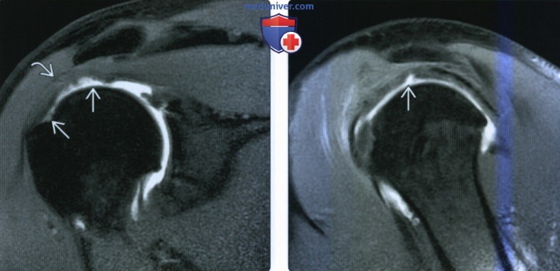 Рентгенограмма, МРТ, УЗИ при частичном разрыве ротаторной манжеты по толщине