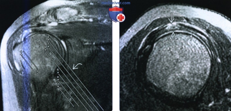 Рентгенограмма, МРТ, УЗИ при частичном разрыве ротаторной манжеты по толщине