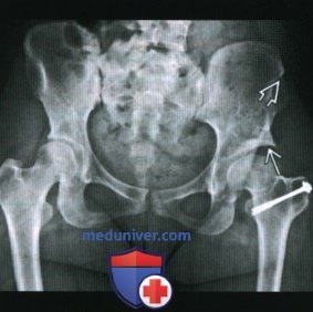 Рентгенограмма, МРТ, УЗИ при дисплазии тазобедренного сустава