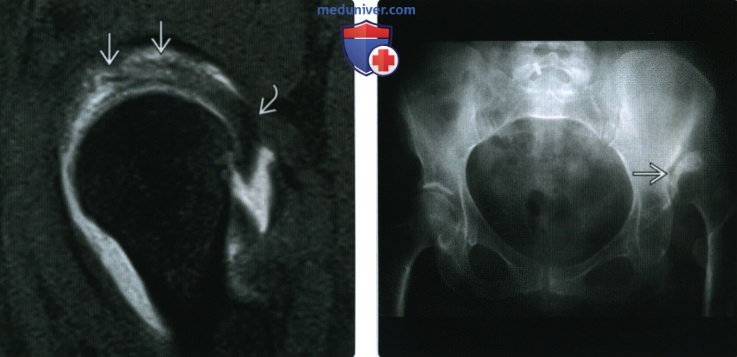 Рентгенограмма, МРТ, УЗИ при дисплазии тазобедренного сустава