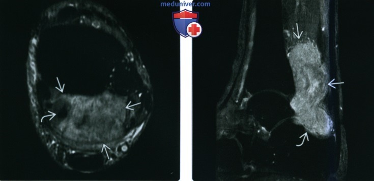 Рентгенограмма, МРТ, УЗИ при гигантоклеточной опухоли сухожильных влагалищ