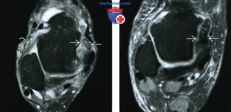 Рентгенограмма, МРТ, УЗИ при импиджмент-синдроме переднего отдела голеностопного сустава