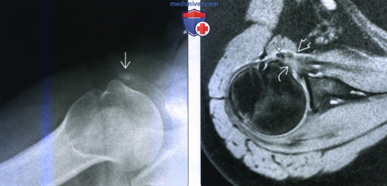 Рентгенограмма, МРТ, УЗИ при кальцифицирующей тендинопатии ротаторной манжеты