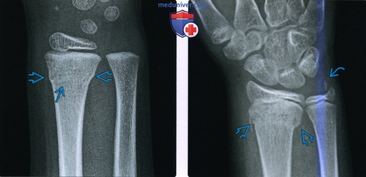 Рентгенограмма, МРТ, УЗИ при ювенильном переломе дистального конца предплечья