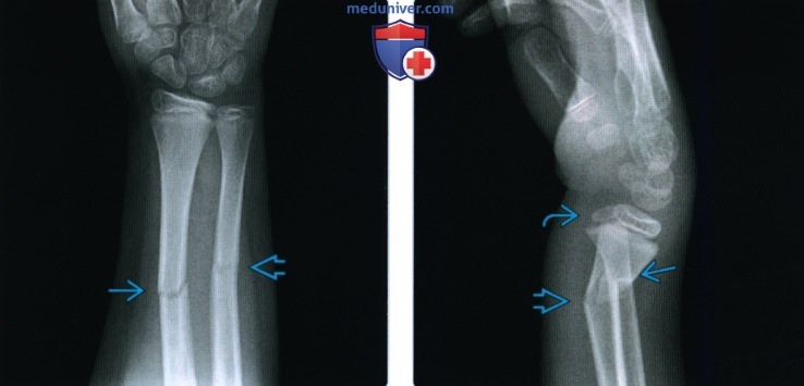 Рентгенограмма, МРТ, УЗИ при ювенильном переломе дистального конца предплечья