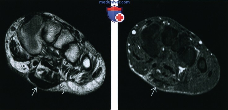 Рентгенограмма, МРТ, УЗИ при поверхностном фиброматозе