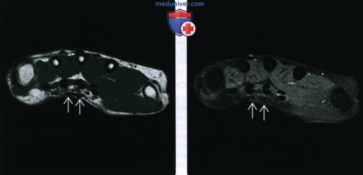 Рентгенограмма, МРТ, УЗИ при поверхностном фиброматозе