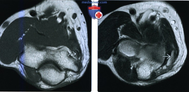 Рентгенограмма, МРТ, УЗИ при повреждении локтевого нерва