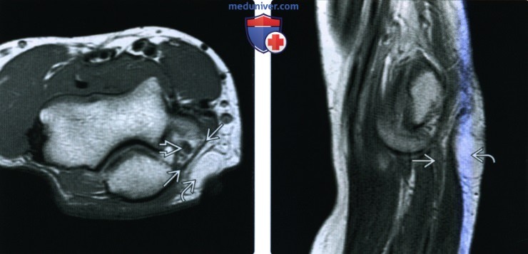 Рентгенограмма, МРТ, УЗИ при повреждении локтевого нерва
