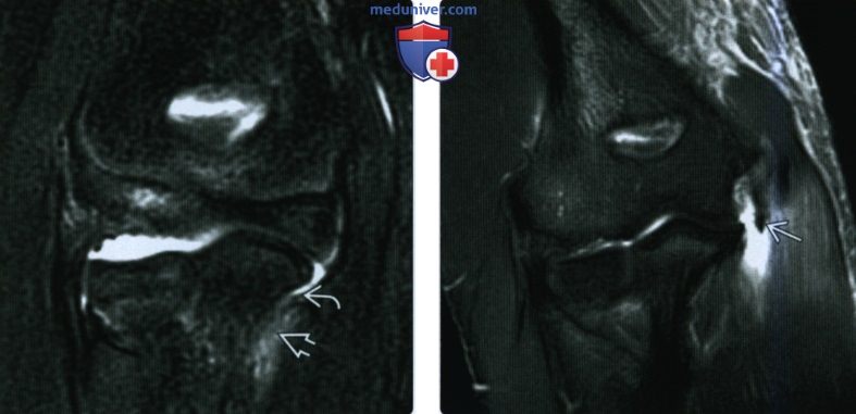 Рентгенограмма, МРТ, УЗИ при повреждении локтевого сустава по типу вальгусной нагрузки